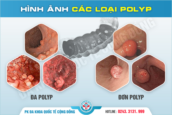 Polyp hậu môn