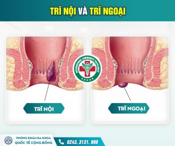 Hiểu rõ cách phân biệt trĩ nội và trĩ ngoại để hỗ trợ chữa bệnh cho đúng