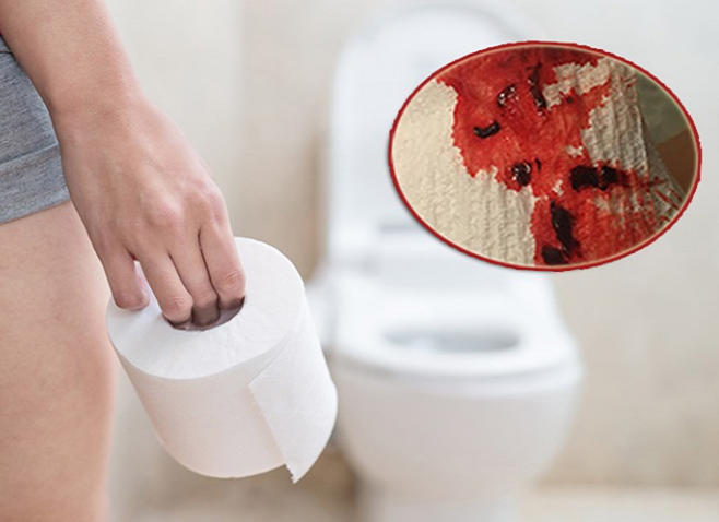 Đại tiện ra máu