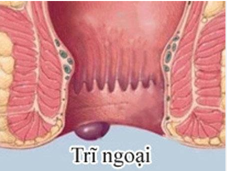 Trĩ ngoại