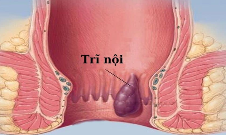 Trĩ nội